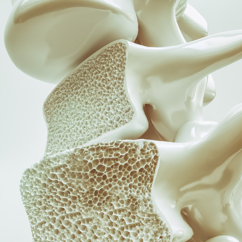 Osteoporosis dr Golnaz Samadi pic1